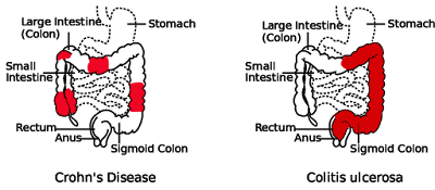 sintomas-colitis-ulcerosa-diarrea-con-sangre