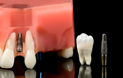 dental implant Mumbai