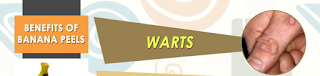 Warts