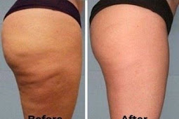 Get Rid Of Cellulite And Strech Marks In Just 2 Days With These 4 Ingredients