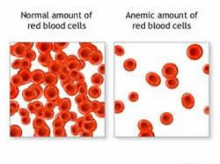 Penyebab dan Cara Mengobati Anemia