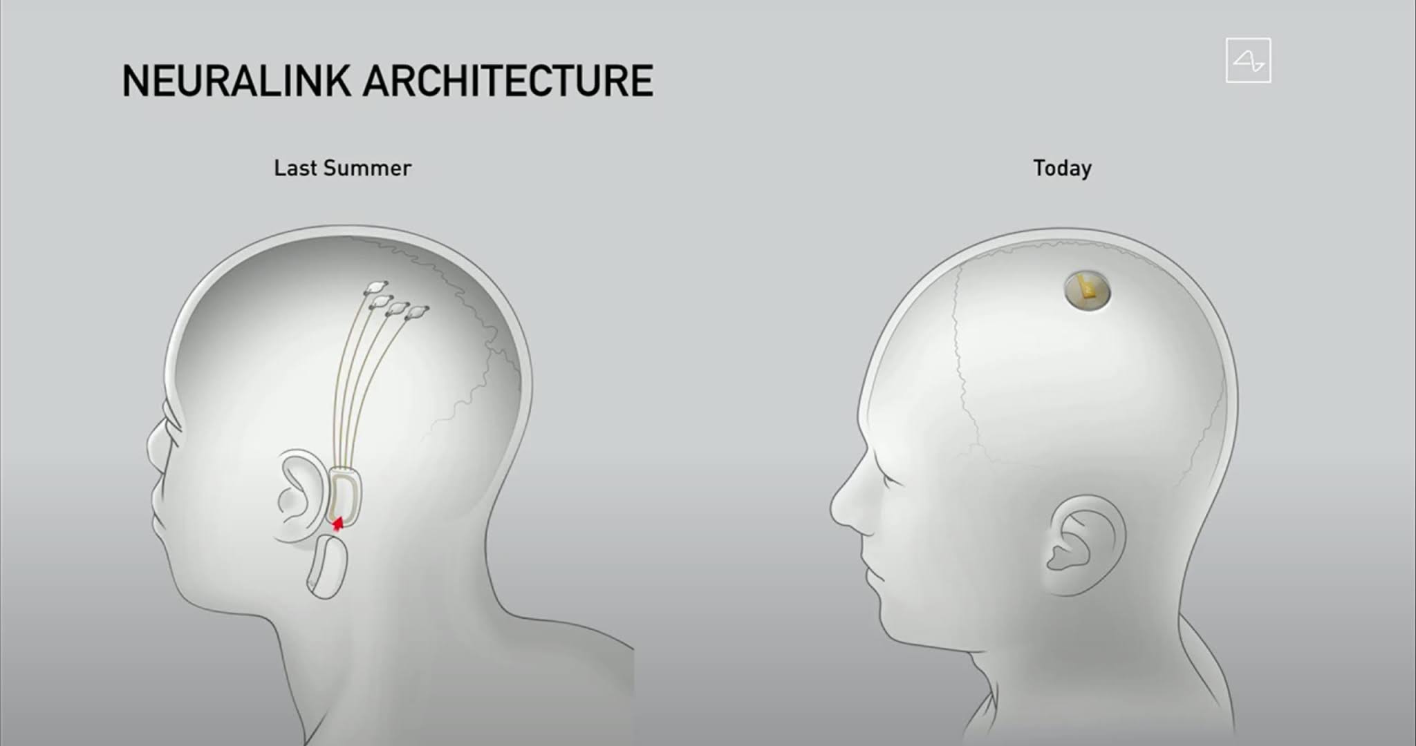 implante neuralink