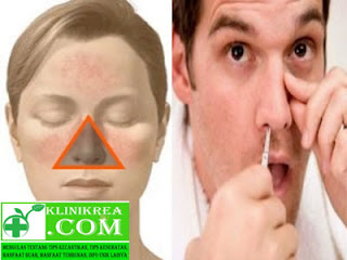 Benarkah Mencabut Bulu Hidung Dapat Menyebabkan Kematian