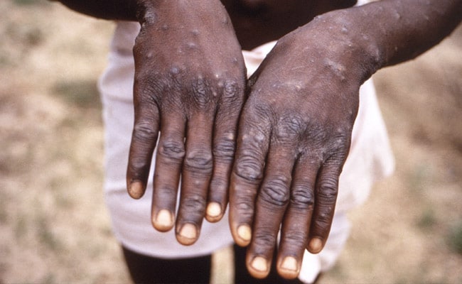 Ghana Recorded Five Times Of Monkeypox Verify By Docs