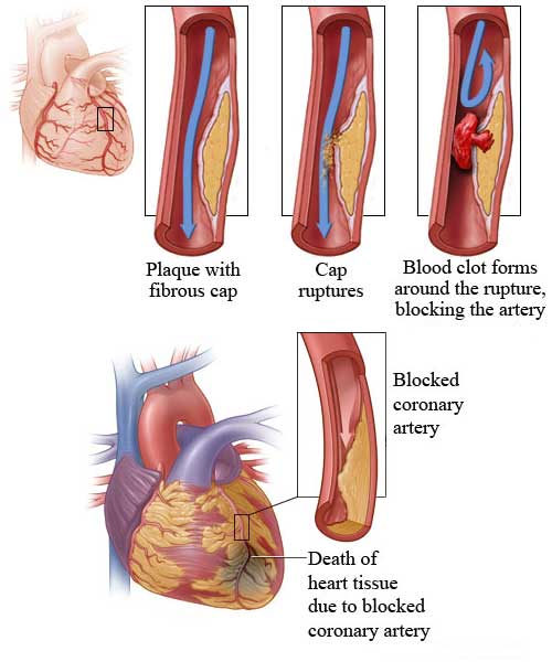 Heart Attack. Symptoms of Heart Attack.