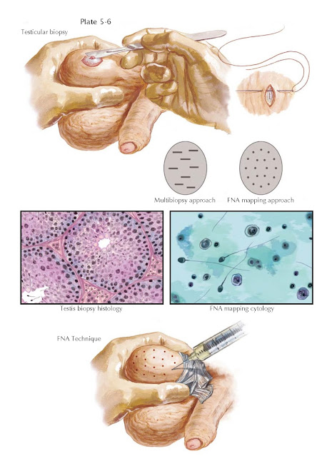 AZOOSPERMIA IV: DIAGNOSTIC PROCEDURES