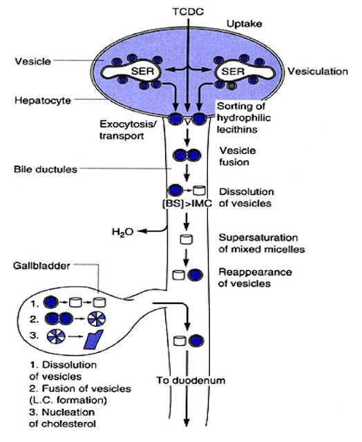 Skematik tentang vesikel sebagai kendaraan kolesterol dalam empedu dan hubungannya dengan nukleasi. *BS=Bile Salt (garam empedu),  IMC = Inter mixed Micellar Concentration, TCDC = taurochenodeoxycholate, dissolution of vesicle, nucleation of cholesterol, supersaturation of mixed micelles, nukleasi kolesterol, supersaturasi mishell, sorting of hydrophilic lesitin, TCDC, duktus biliaris, eksositosis,vesiculation, vesikulasi