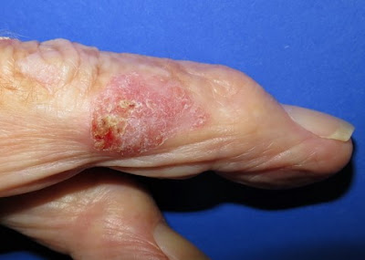 Bowen's Disease Pictures3