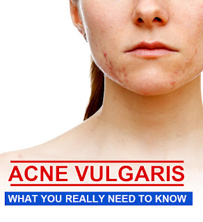 Acne Vulgaris: What You Really Need to Know