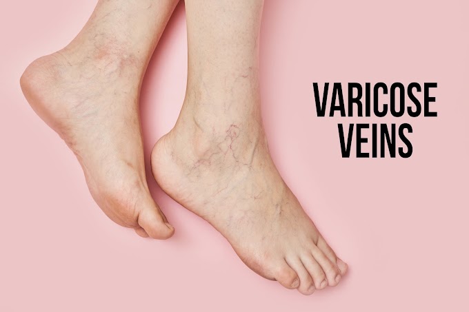 Healing Varicose Veins Naturally: Ayurvedic Treatment
