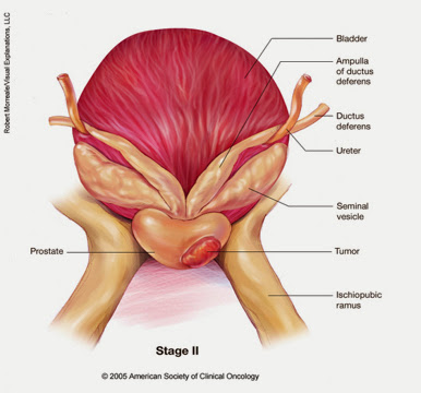 Stage II (stage B) Prostate cancer