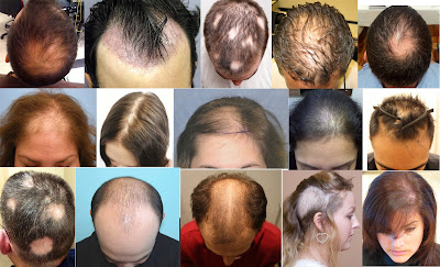 Tóc rụng từng mảng – Nguyên nhân và cách khắc phục