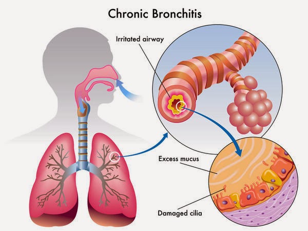 Chronic Bronchitis Causes, Symptoms, Diagnosis, Treatment ...