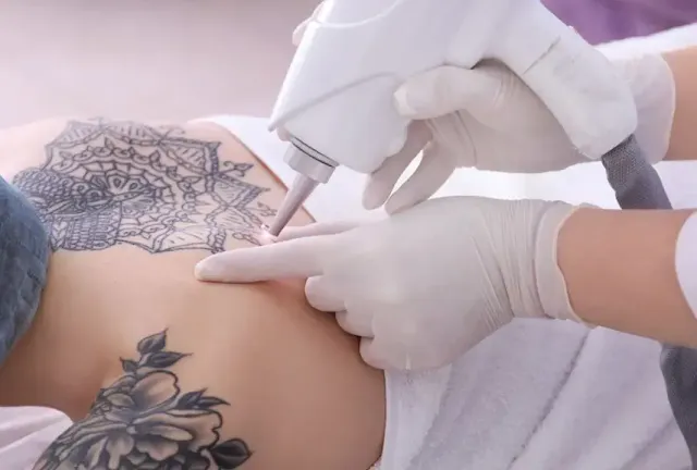 A massive tattoo on shoulder removal