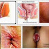 Cari Obat Ampuh Alami Anti Ambeien Dalam thumbnail