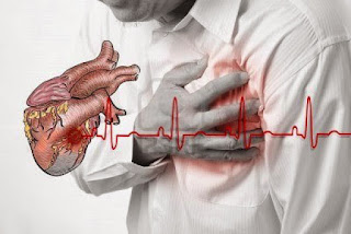 Cara Menyembuhkan Penyakit Jantung Koroner