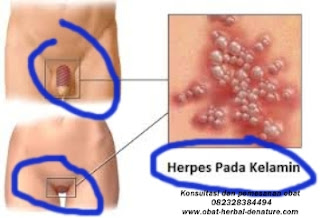 obat herpes kelamin,obat herpes zoster,obat cacar dompo,obat cacar air,obat herpes kemaluan,obat herpes tangan,obat herpes bibir,obat herpes badan