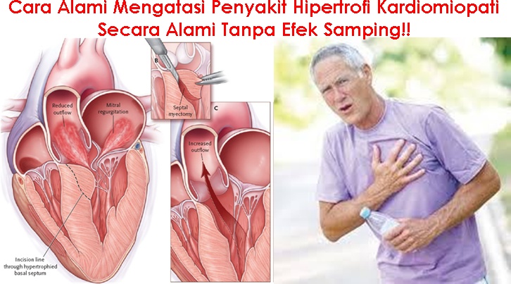 Obat Tradisional Hipertrofi Kardiomiopati