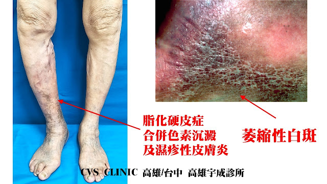 靜脈曲張伴隨脂化硬皮症, varicose veins with lipodermatosclerosis