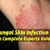 What you have to think about fungal infections - Causes, Symptoms and diagnosis!
