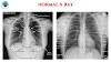 Abnormal Chest X-ray Interpretation 