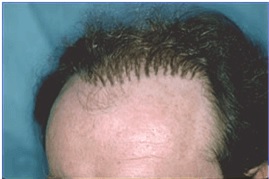 L'aspetto dei "capelli da bambola" era una lamentela comune delle prime tecniche di trapianto di capelli