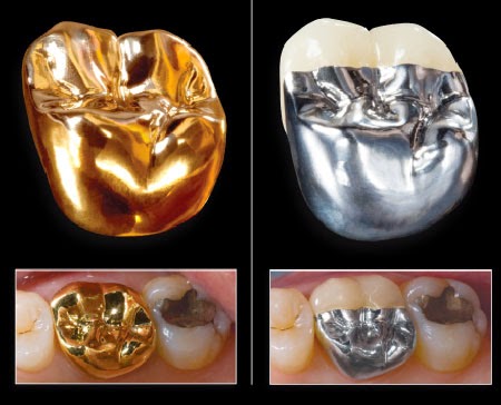 Răng sứ làm từ kim loại quý