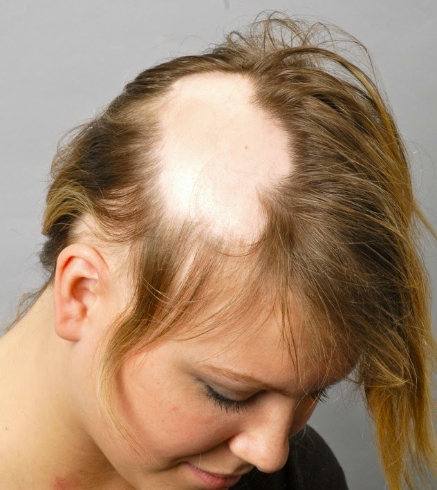 alopecia areata pic