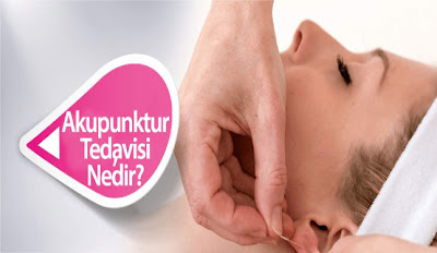 Akupunktur Nedir?