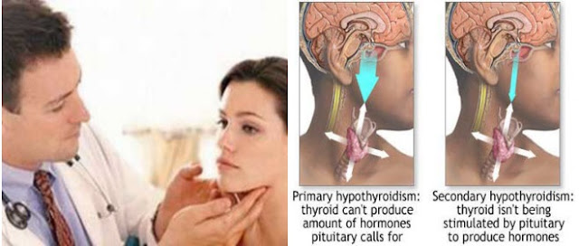 Hypothyroidism in women