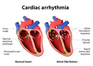 Heart diseases, symptoms and treatments