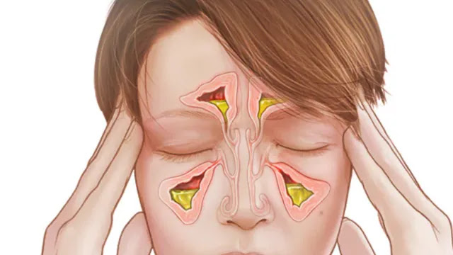 SINUS INFECTION : CAUSES, HOME REMEDIES AND MEDICINES