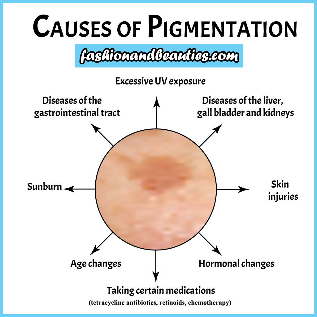 Causes of Pigmentation Issues