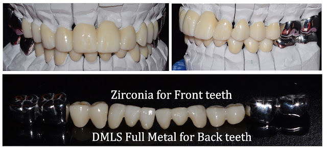 Zirconia and DMLS Full Metal Crowns