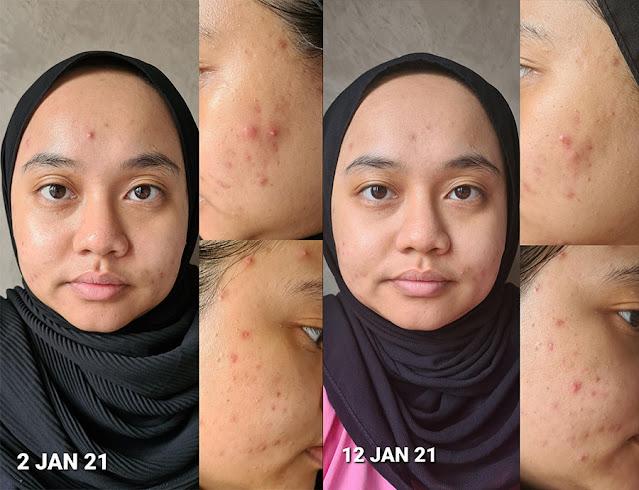 Before & After Using Aprilskin Carrotene Serum