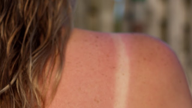 Symptoms of Sunburn, causes, home remedies and treatments to avoid