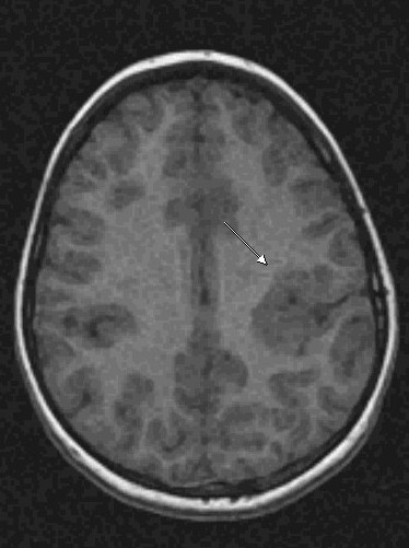 Seizures In Adults. of epilepsy in adults.