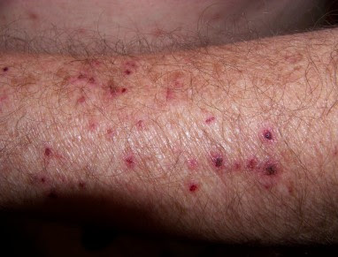 Morgellons Disease Pictures4