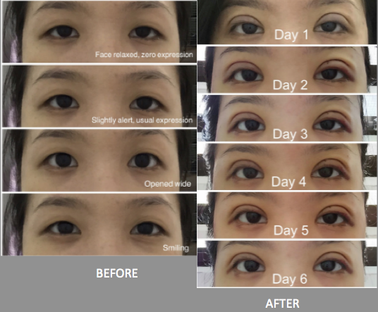 Double eyelid surgery Singapore