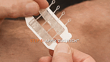 ZipStitch Laceration Kit, Close Your Gaping Wound Without Having To Go To Emergency Room For Stitches
