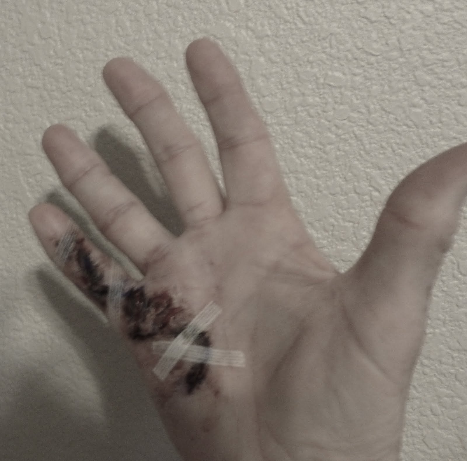 A Little Finger Surgery Update