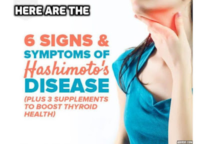 Hashimoto’s Disease Treatment – 3 Supplements to Boost Thyroid Health. An in-depth look at Hashimoto’s Disease, what factors increase your risk, and what you can do to reverse the condition.