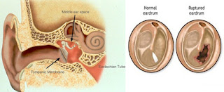 Pengobatan Gendang Telinga Pecah