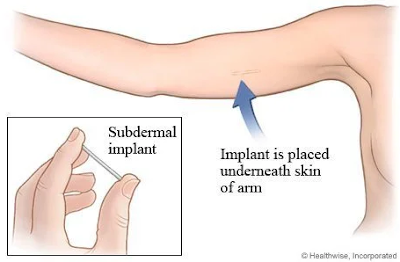 askep kb implant