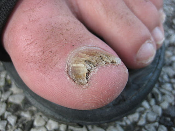 Toe Fungus and Home Remedies