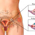 CLEAN THE OVARY CYSTS WITH THE BEST RECIPES!..OVARY CYST CAUSE BLOATING, LOWER ABDOMINAL PAIN, OR LOWER BACK PAIN