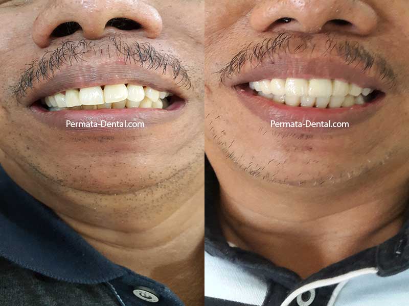 Ahli Gigi Bali Permata Dental Merapikan Gigi Yang Maju 