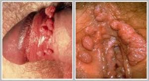 Apa Itu Injection Hpv