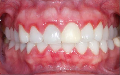 Đau răng không bị sâu có nên nhổ bỏ không?-1