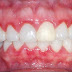 Đau răng không bị sâu có nên nhổ bỏ không?